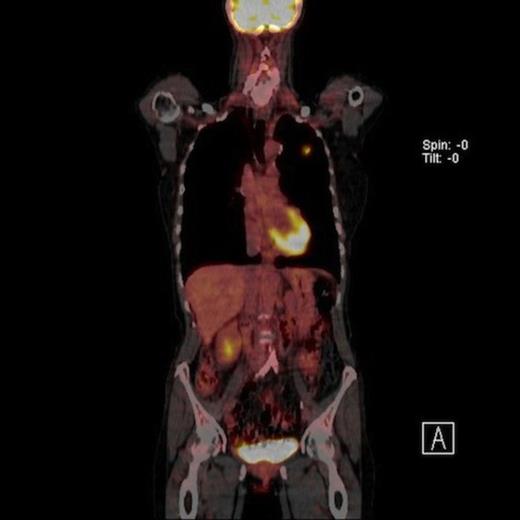 Coronal view PET CT scan of a high uptake nodule in the left upper lobe