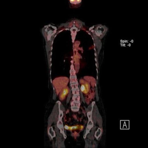 Coronal view of PET CT scan of moderate uptake synchronous nodule in the left upper lobe