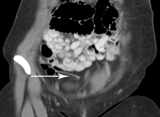 CT scan showing elongated appendix