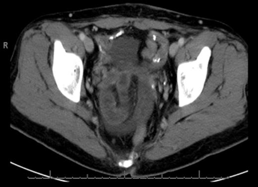 Area in pelvis of concern for Close-Loop SBO