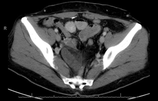 Pelvis, distended SBO