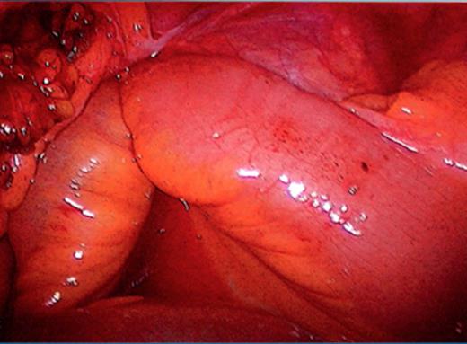 Normal looking bowel in pelvis.