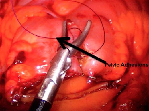 Anastomosis after small bowel resection