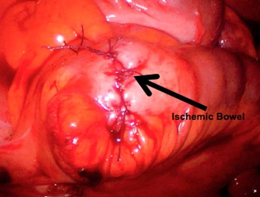 Completed anastomosis