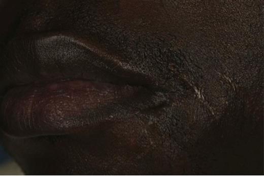 showing scarring to the left mental region with evidence of previous revision surgery and a draining cutaneous sinus