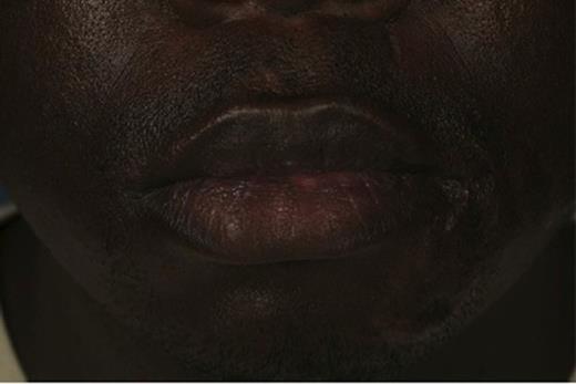 Image showing scarring to the left mental region with evidence of previous revision surgery and a draining cutaneous sinus