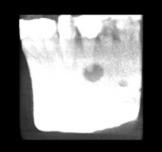CT showing gutta percha point communicating with the periapical area
