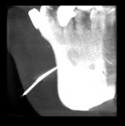 CT showing gutta percha point communicating with the periapical area