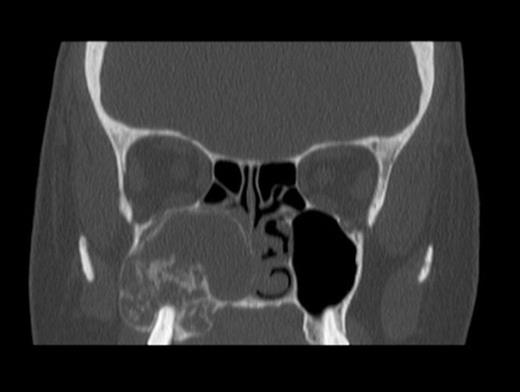 CT Scan revealing a large right maxillary antral mass