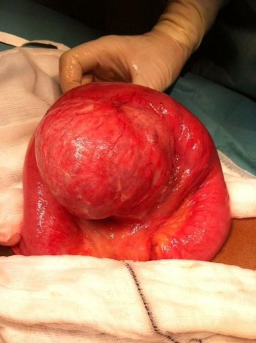 Intra-operative photograph demonstrating jejunal diverticulum