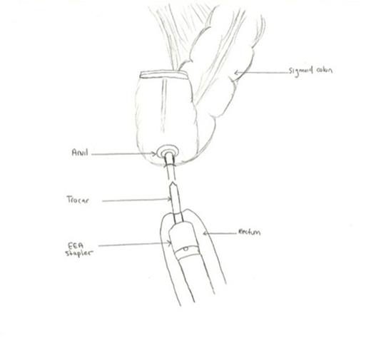 Baker-type side-to-end anastomosis