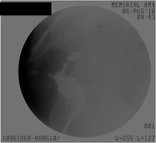 Gastrograffin enema demonstrating normal anastomosis with no leak