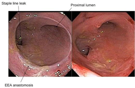 Flexible sigmoidoscopy shows healed EEA anastomosis