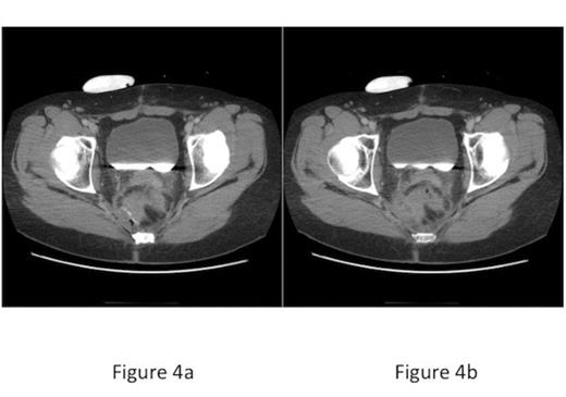 CT scan of abdomen/pelvis a) Small amount of free air adjacent to linear staple line, b) Abscess adjacent to linear staple line