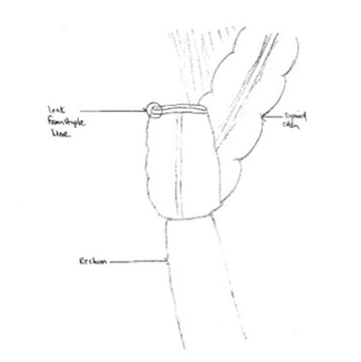 Leak site from linear staple line
