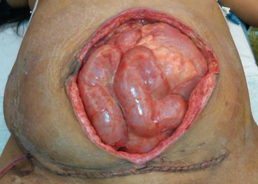 Open abdomen technique was used to facilitate the multiple operations. Note the loss of a portion of the anterior abdominal wall from the serial debridements.