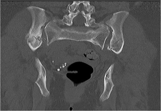 Coronal computerised tomography (CT) image demonstrating bilateral posterior iliac wing fractures and sacro-iliac joint disruption