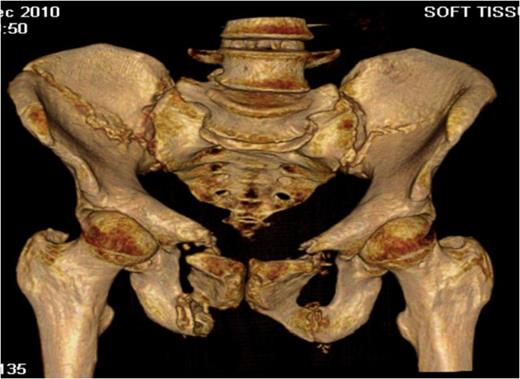 Three-dimensional CT reconstruction showing both the bilateral crescent and superior and inferior pubic rami fractures