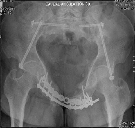 Inlet radiograph at 16 months post surgery demonstrating solid fixation and bony healing