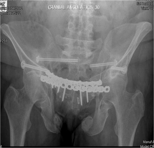 Outlet radiographs at 16 months post surgery demonstrating solid fixation and bony healing