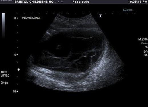 Ultrasound image of longitudinal view of multicystic pelvic mass