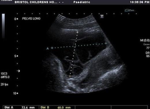 Ultrasound image of coronal view of multicystic mass