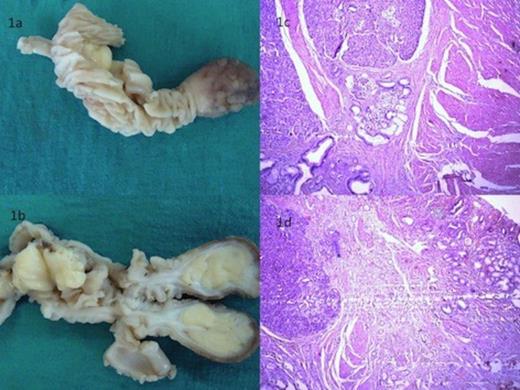 Surgical specimen of resected ileal polyp with adjacent bowel loop (1a) cut surface of which was pale yellow (1b). Histological examination revealed presence of pancreatic tissue in muscularis propria of ileum (1c) (H&E, x40) with overlying mucosa showing congestion and metaplasia (1d) (H&E, x40)