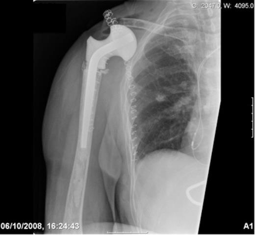 Post-operative radiograph demonstrating reconstruction using a hip spacer following extra-articular scapula resection