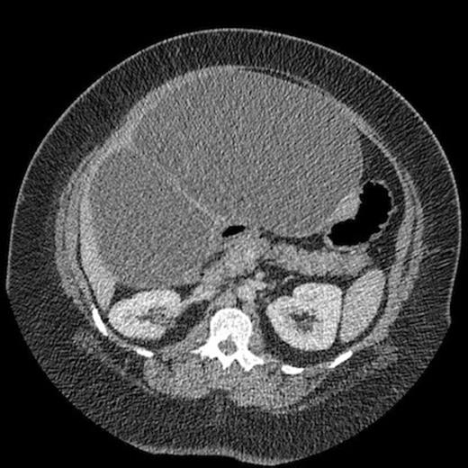 Computed tomography demonstrating large intrahepatic septated cystic lesion