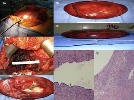Gross appearance of Hepatic cystadenoma.Fig. 2b & 2c: Gross appearance of enucleated Hepatic Cystadenoma following Decompressive Cystotomy.Fig. 2d: Exposed Hepatic Parenchyma following Argon Beam Coagulation and Thrombin – Soaked Gelfoam Application.Fig. 2e: Gross Specimen demonstrating Ovarian Stroma Characteristics.Fig. 2f: Photomicrograph demonstrates normally arranged cuboidal epithelium and mucin overlying dense ovarian stroma.Fig. 2g: Photomicrograph demonstrates infiltrative atypical glands.