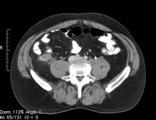 CT showing thickened appendix