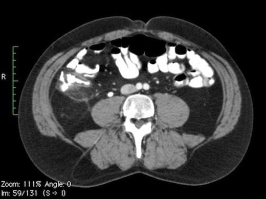 CT scan showing calculus in right mid-ureter