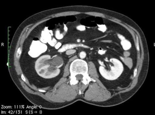 CT scan showing moderate hydronephrosis