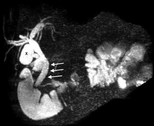 MRCP shows the residual gallbladder (“X”), and the dilated common bile duct with stones (white arrows)