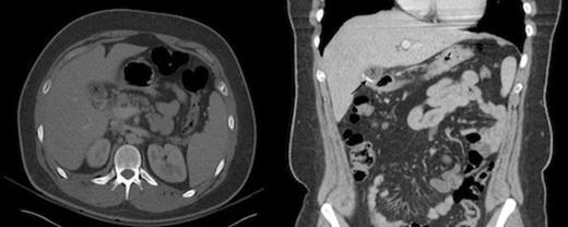 CT of the abdomen demonstrates the residual portion of the gallbladder, marked by an “X” in both the axial and coronal views. The staple line, indicated by a black arrow, is seen best on the coronal imaging