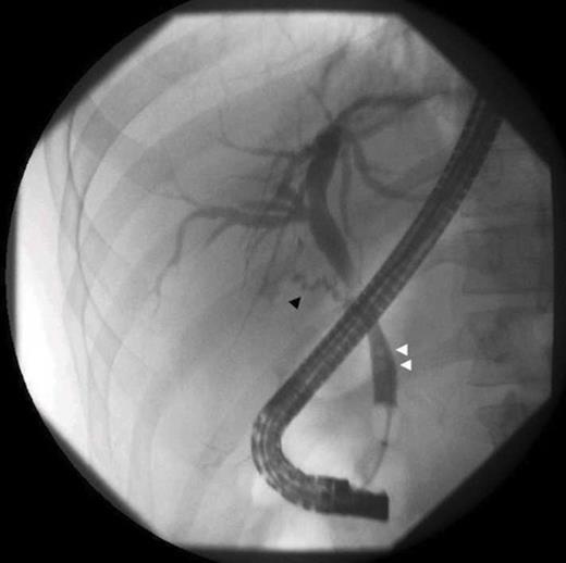 ERCP shows a residual cystic duct (black arrow), and choledocholithiasis (white arrows)