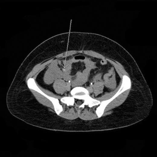 CT angiogram of the abdomen and pelvis revealed active extravasation within the right lower quadrant