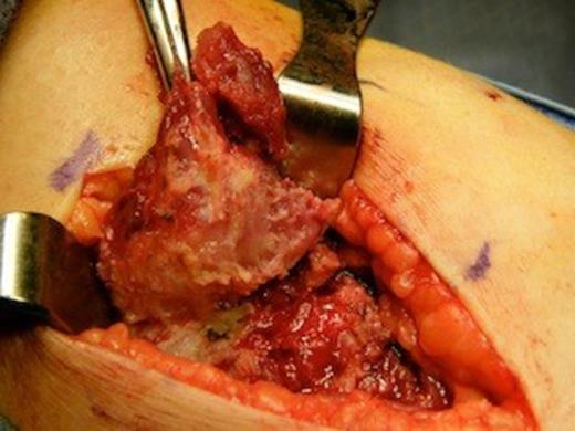 Signet ring cell carcinoma