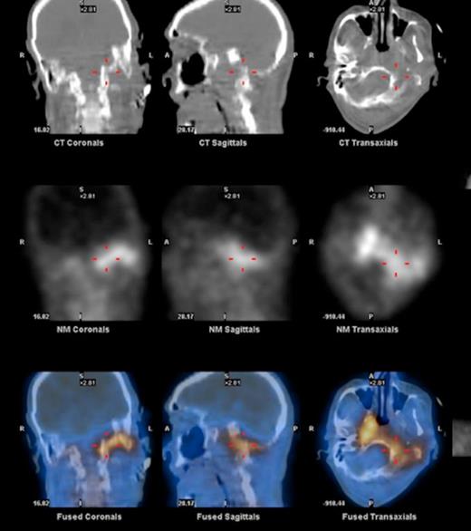 Imaging demonstrating extent of disease