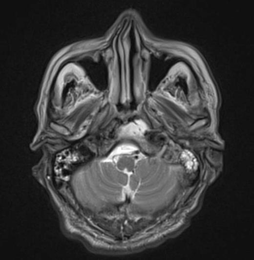 Imaging demonstrating extent of disease
