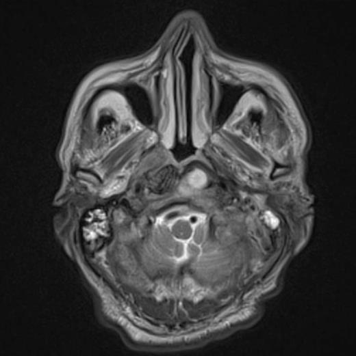 Imaging demonstrating extent of disease
