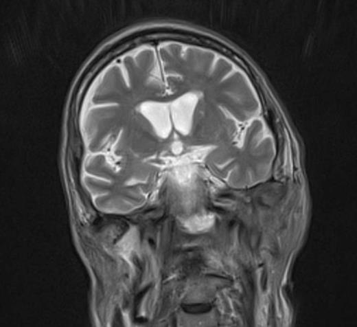 Imaging demonstrating extent of disease