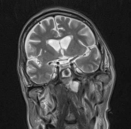 Imaging demonstrating extent of disease