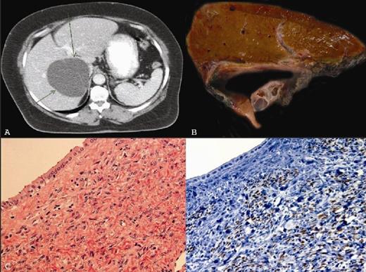 1A) Contrast enhanced computed tomography (CT) demonstrating a cystic lesion in the right hepatic lobe with thin septations. 1B) Partial right lobectomy specimen showing subcapsular multiloculated cyst. 1C) The multiloculated cysts lined by mucinous columnar and/or cuboidal epithelium with surrounding subepithelial ovarian-type stroma (H&E, X 400). 1D) The ovarian-type stroma was positive for oestrogen receptor (Immunohistochemistry, X400)