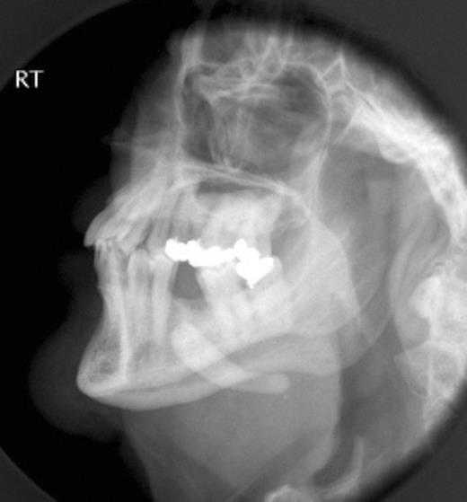 Plain radiograph demonstrating large radiopaque submandibular mass