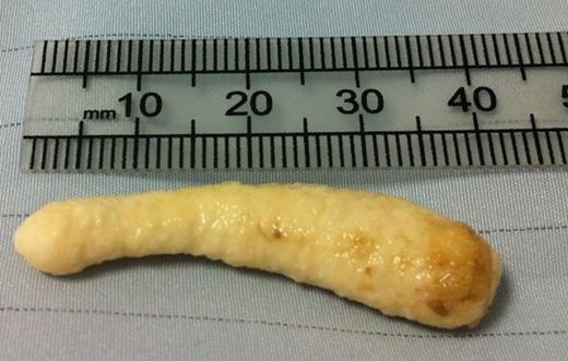 Irregular submandibular sialolith, measuring 40mm
