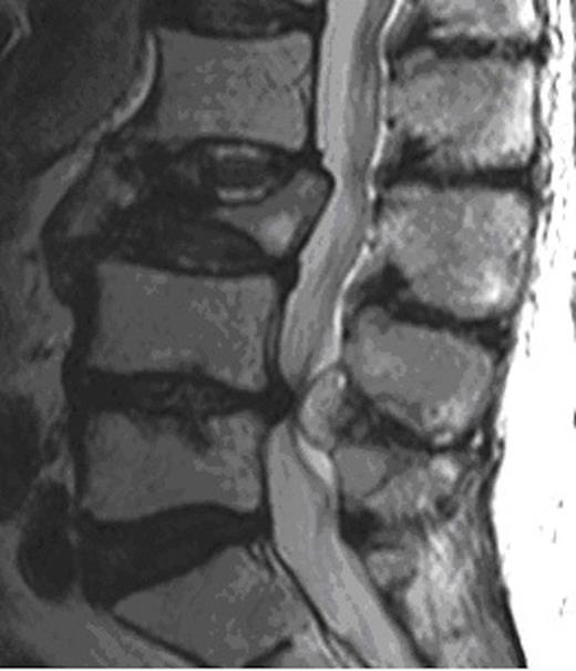 MRI demonstrating synovial cyst