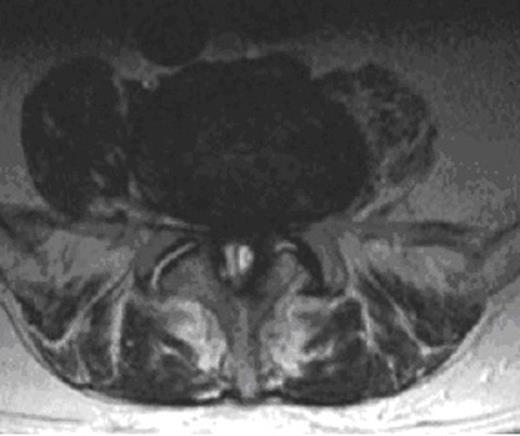 MRI demonstrating synovial cyst