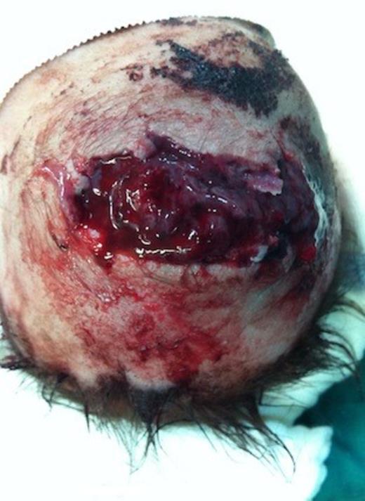 Intra-operative photograph showing the entrance wound