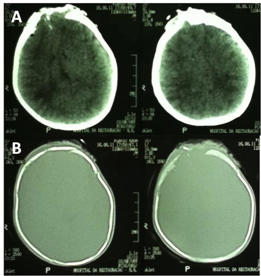 Initial CT scan showing frontal contusion (A) and bone window images revealing frontal skull fracture (B).